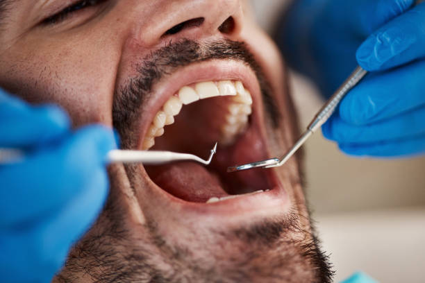 Best Emergency Dental Filling Replacement  in Lan, MI
